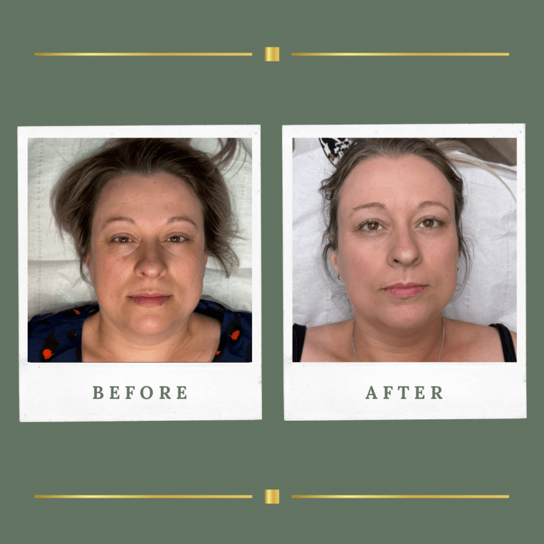 HIFU non surgical facelift Nottignhamshire