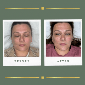 Microdermabrasion Nottinghamshire