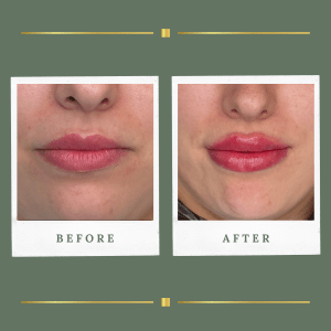 Lip Filler Nottinghamshire