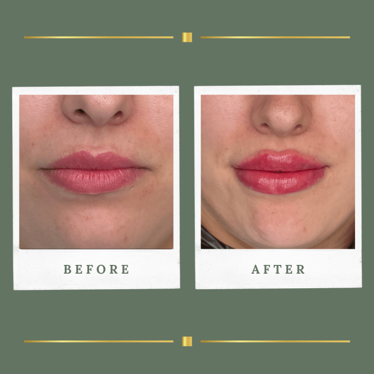 Lip Filler Nottinghamshire