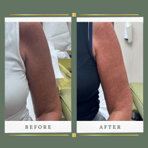 HIFU body sculpting treatment targeting stubborn fat and loose skin for natural contouring