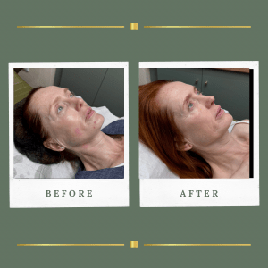 HIFU Treatments | Lift, Sculpt and Restore with 3 Sessions