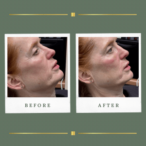 BioRePeel Treatment Nottinghamshire | No Downtime Skin Peel