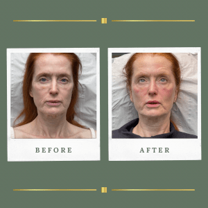 HIFU Treatments | Lift, Sculpt and Restore with 3 Sessions
