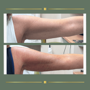 HIFU body sculpting treatment targeting stubborn fat and loose skin for natural contouring